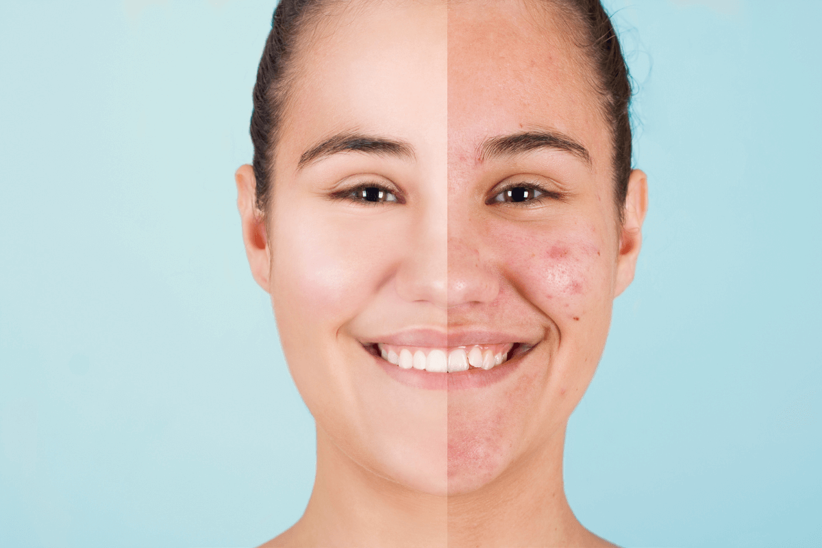 Limpeza de Pele Antes e Depois